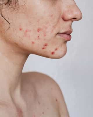 Acne no adulto: porque aparece e como controlar?