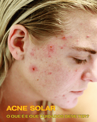 Acne solar: o que é e que cuidados deve ter?