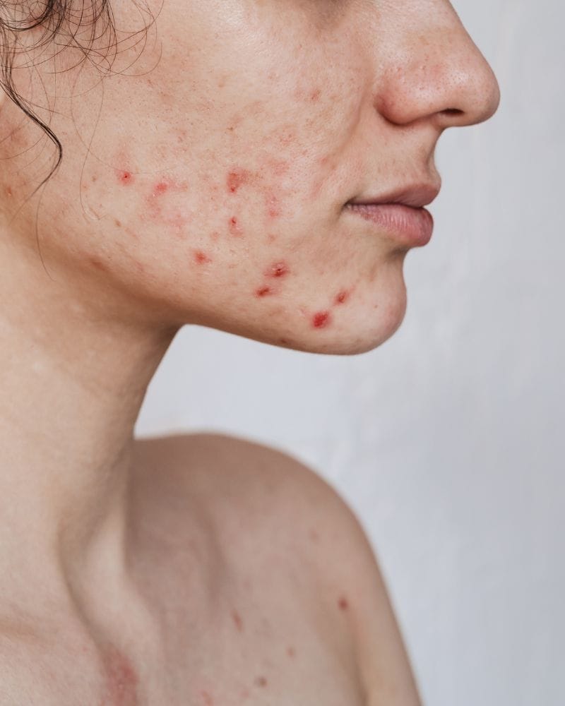 Acne no adulto: porque aparece e como controlar?